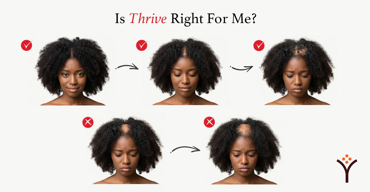 Illustration showing the 5 stages of hair loss