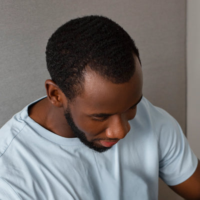 Receeding Hairline