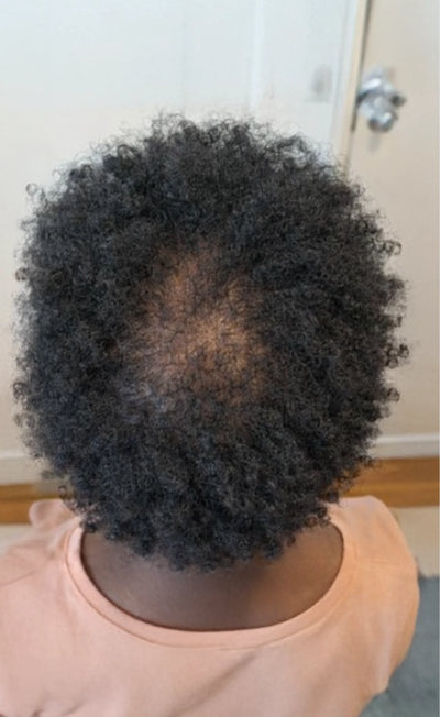 Person with textured hair and hair loss in a room with a neutral backgroun